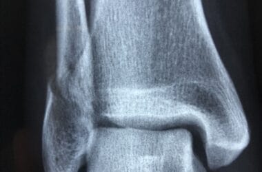 radiography, diagnosis, anatomy, injury, radiology, bone, healthcare, xray, health, medical, disease, ankle, sprain, fracture, blue health, blue medical, blue healthcare, xray, xray, xray, xray, xray, ankle, fracture-3057768.jpg