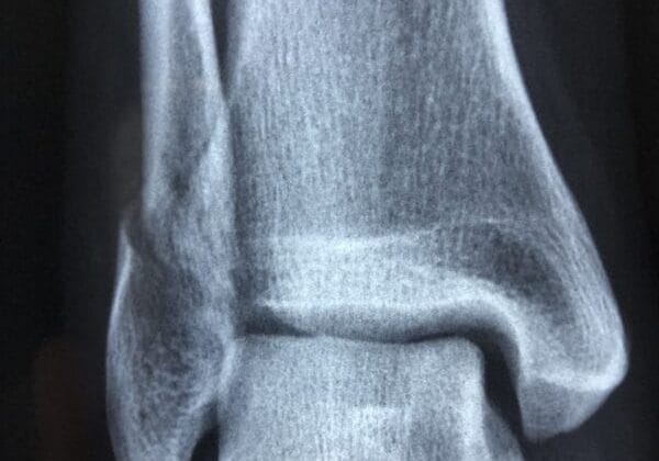 radiography, diagnosis, anatomy, injury, radiology, bone, healthcare, xray, health, medical, disease, ankle, sprain, fracture, blue health, blue medical, blue healthcare, xray, xray, xray, xray, xray, ankle, fracture-3057768.jpg